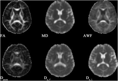 Analysis of white matter tract integrity using diffusion kurtosis imaging reveals the correlation of white matter microstructural abnormalities with cognitive impairment in type 2 diabetes mellitus